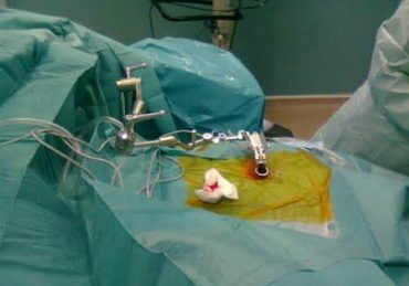Chirurgie mini-invasive