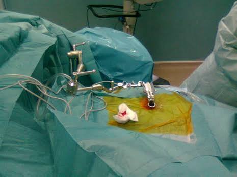 Chirurgie mini-invasive